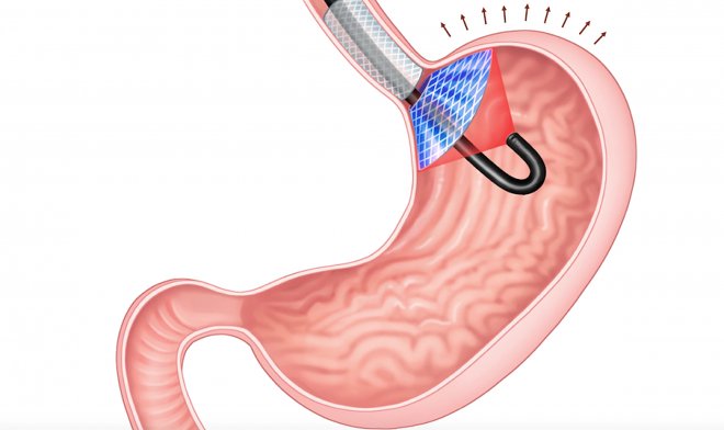 Лазерный имплант в желудке поможет бороться с ожирением 